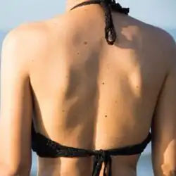 Body Moles