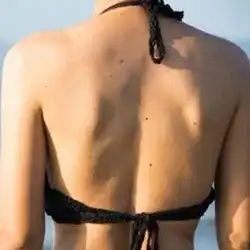 Add Head & Body Moles & Freckles